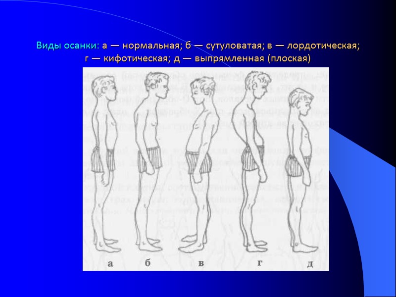 Виды осанки: а — нормальная; б — сутуловатая; в — лордотическая; г — кифотическая;